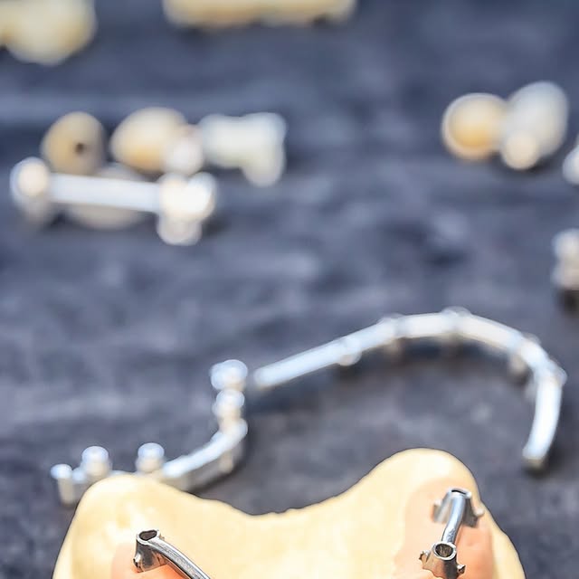 Inlay-core et reconstitution — Dentalis France
