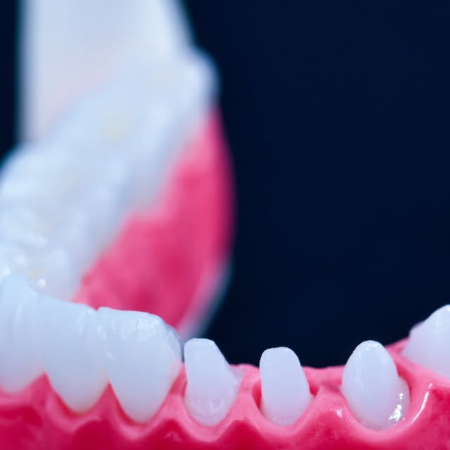 Stratification céramique — Dentalis France